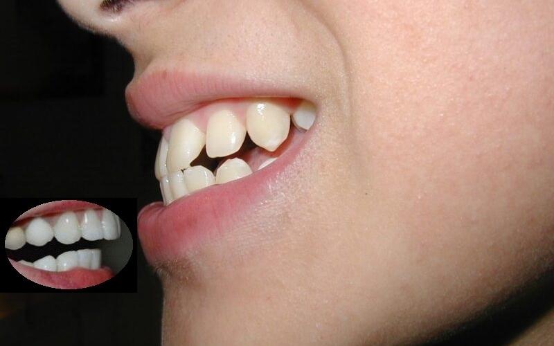 Chỉ trong một thời gian ngắn, bọc răng sứ có thể cải thiện tình trạng răng hô