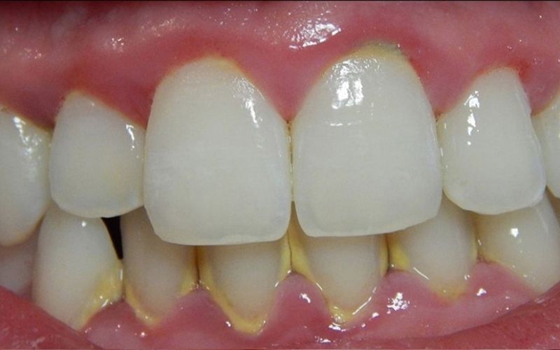 Mảng bám thức ăn là một trong những nguyên nhân gây ra hiện tượng hôi miệng sau khi bọc răng sứ