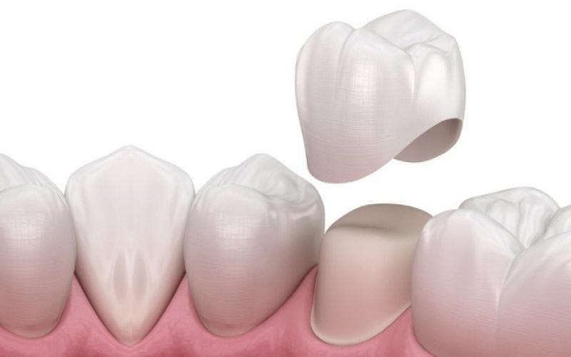 Bọc răng sứ là kỹ thuật nha khoa giúp phục hình răng hiệu quả