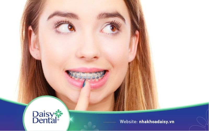 Răng bọc sứ có niềng được không ?
