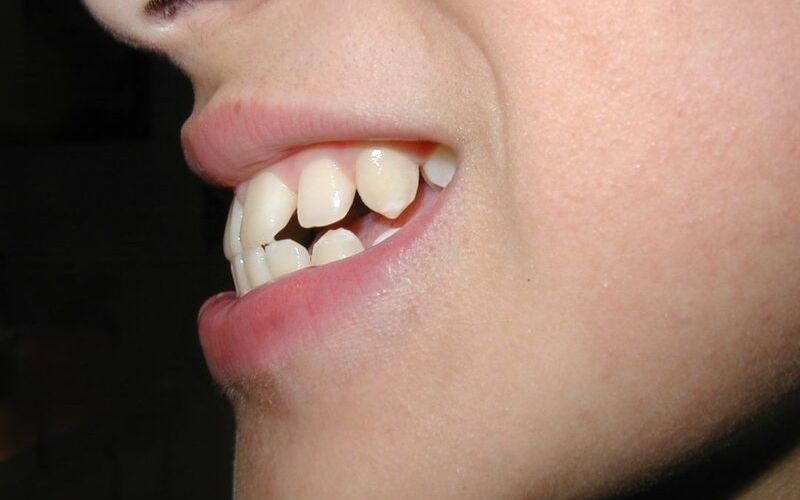 Răng hô, móm nhẹ là tình trạng răng bác sĩ thực hiện bọc mão răng sứ