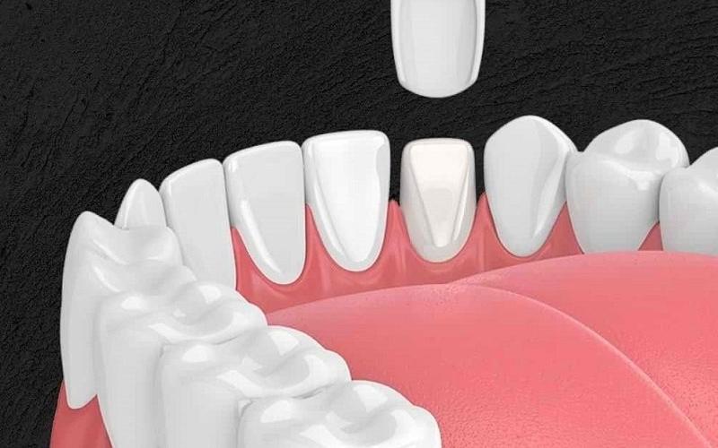 Nên tìm hiểu kỹ về phương pháp bọc răng sứ trước khi thực hiện