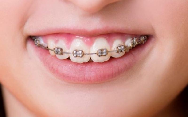 Niềng răng khắc phục hoàn hảo tình trạng răng hô
