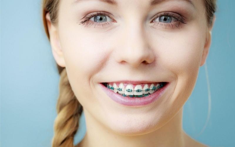 Độ tuổi vàng của niềng răng còn ở trong khoảng 12 - 15 tuổi