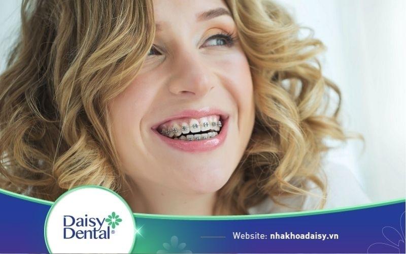 30 tuổi niềng răng được không