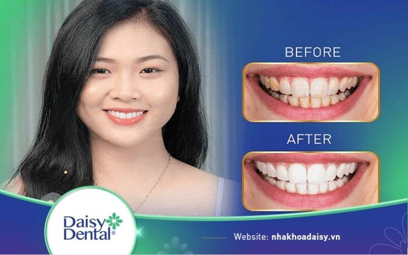 Hình ảnh trước và sau khi bọc răng sứ tại Nha khoa Quốc tế DAISY