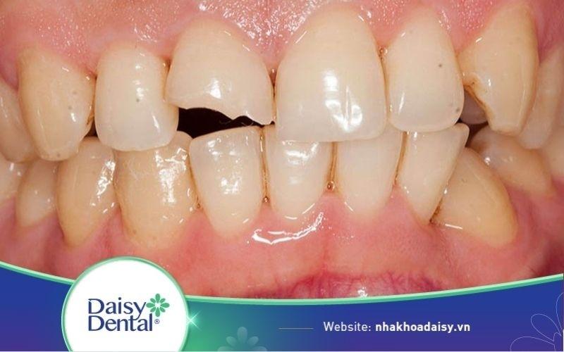 Răng bị bể lớn có bọc sứ được không?