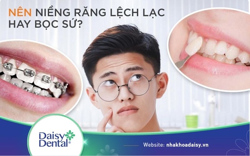 Răng lệch lạc nên niềng hay bọc sứ