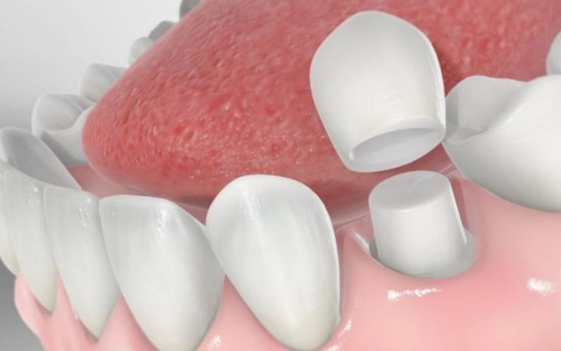 Bọc răng sứ giống như một “lớp áo” bảo vệ giúp răng khỏe mạnh hơn