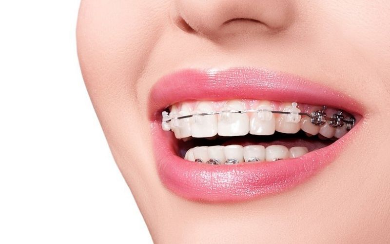Bạn có thể sử dụng niềng răng để thay thế cho bọc răng sứ