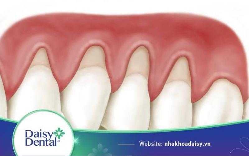 Bọc răng sứ bị tụt lợi