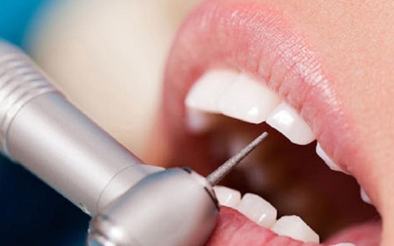 Bọc răng sứ cần mài cùi răng nhiều hơn và đòi hỏi tay nghề cao