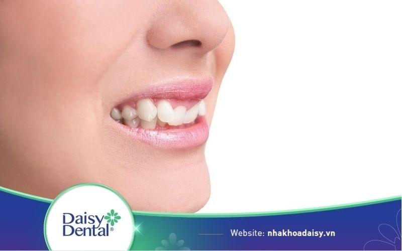 Bọc răng sứ cho răng khấp khểnh