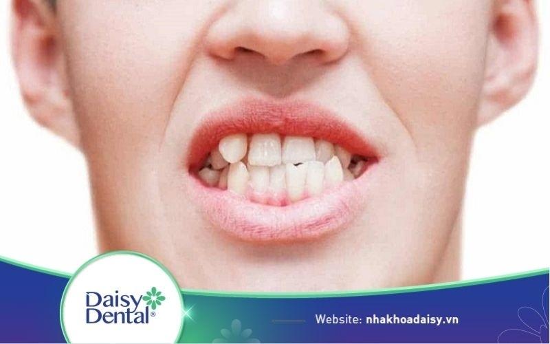 Bọc răng sứ cho răng mọc lệch