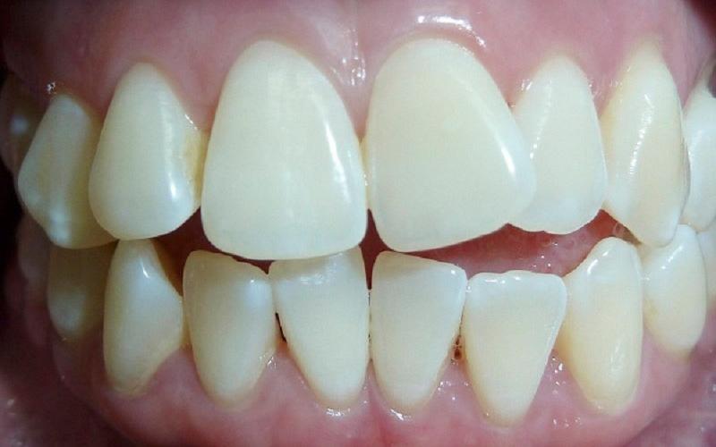 Bọc răng sứ cải thiện tình trạng khấp khểnh nhanh chóng