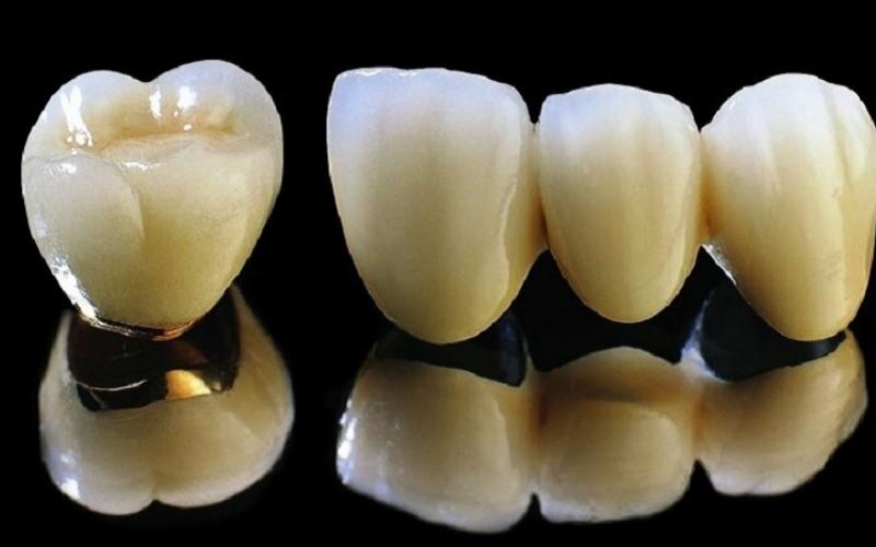 Răng sứ Titan sử dụng được từ 10 - 15 năm hoặc hơn