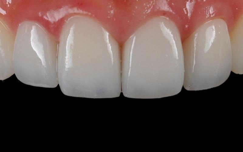 Răng sứ toàn sứ được xem là sự lựa chọn tối ưu để bọc sứ 6 răng cửa