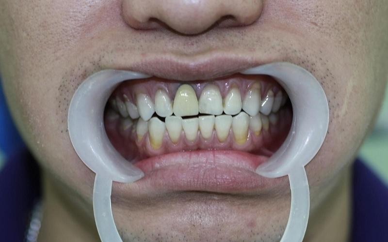 Bọc răng sứ Titan dễ gặp tình trạng đen viền nướu