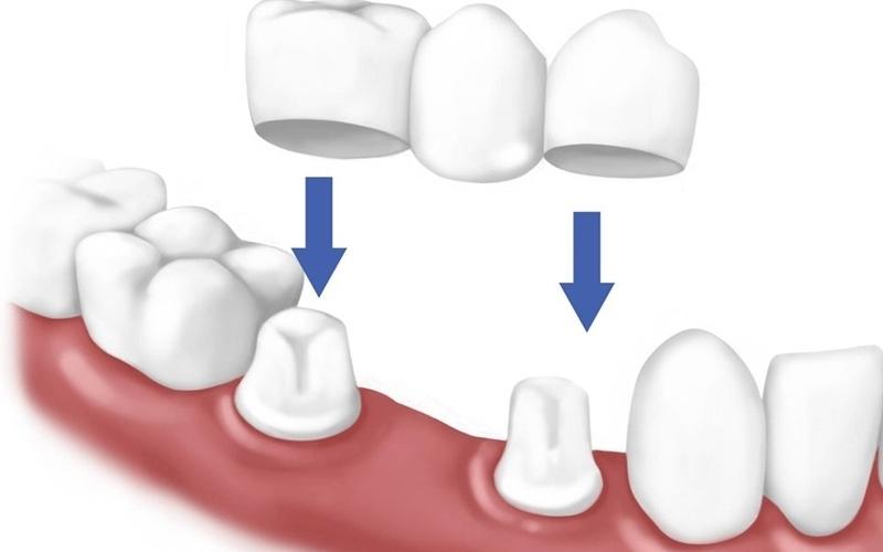 Cầu răng sứ áp dụng cho trường hợp bị mất một hoặc nhiều răng nhưng vẫn còn trụ 2 bên