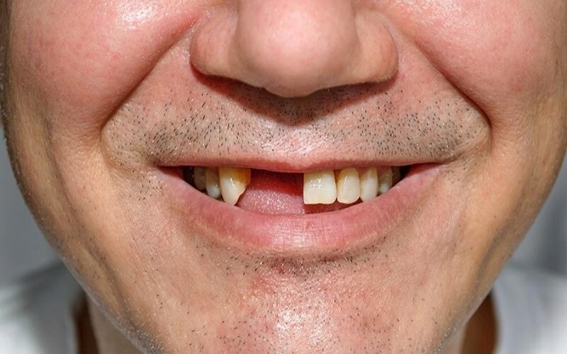 Cầu răng sứ Titan khắc phục khuyết điểm mất răng