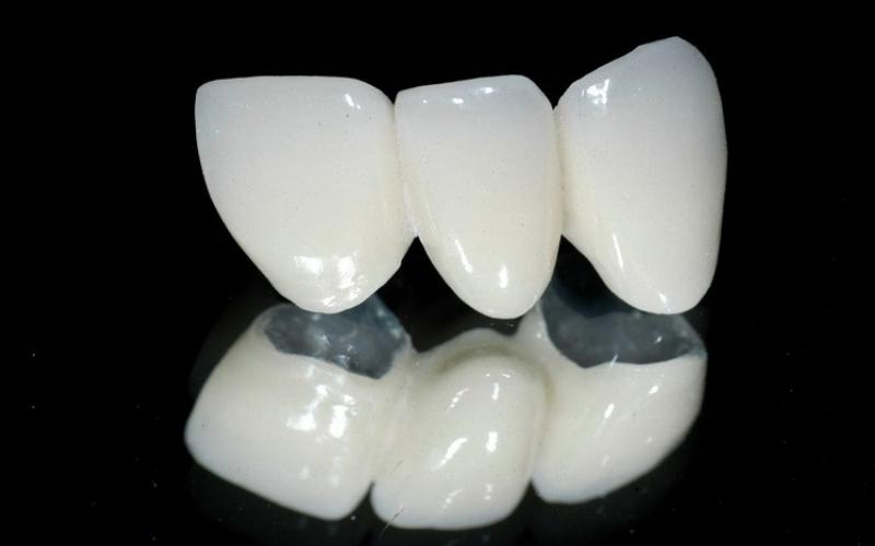 Cầu răng sứ Titan được nhiều người ưa chuộng nhất hiện nay