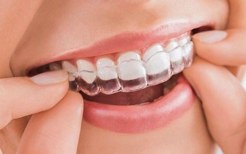 Khay niềng trong suốt Invisalign là một trong những phương pháp chỉnh răng hô hiệu quả