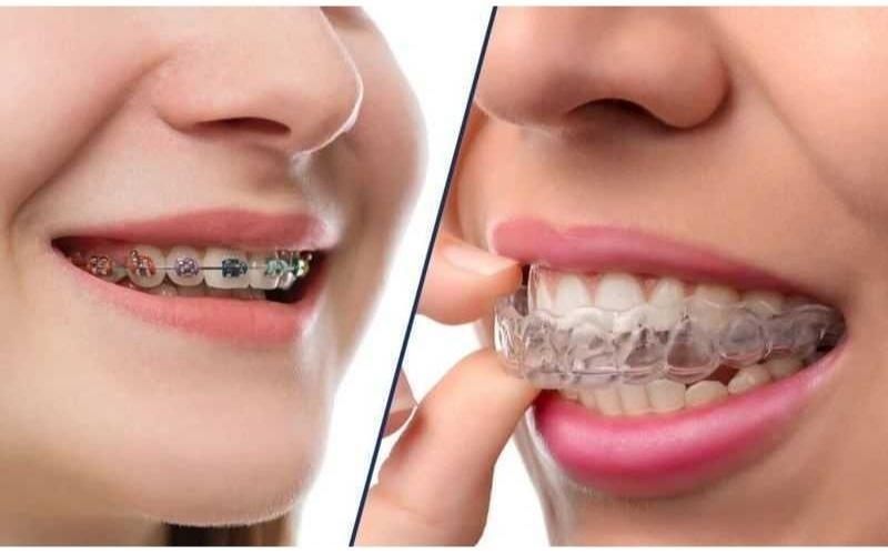 Răng bị quặp vào trong có thể sử dụng niềng răng mắc cài và không mắc cài