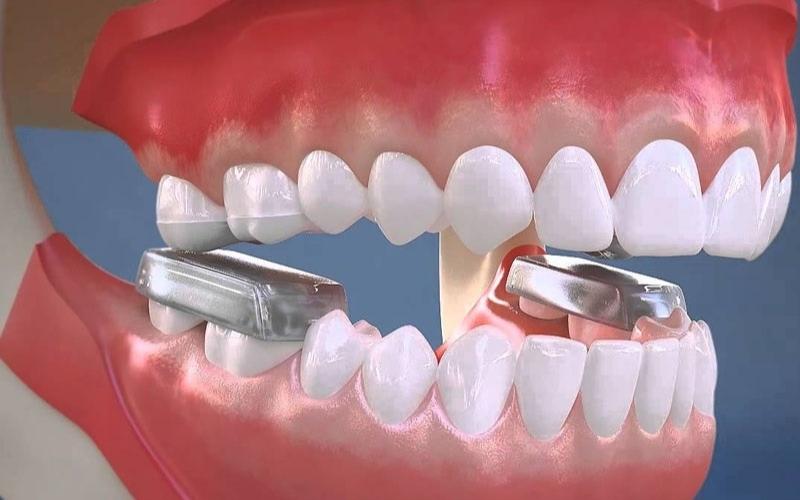 Cục nâng khớp thường được chỉ định trong tình trạng khớp cắn sâu
