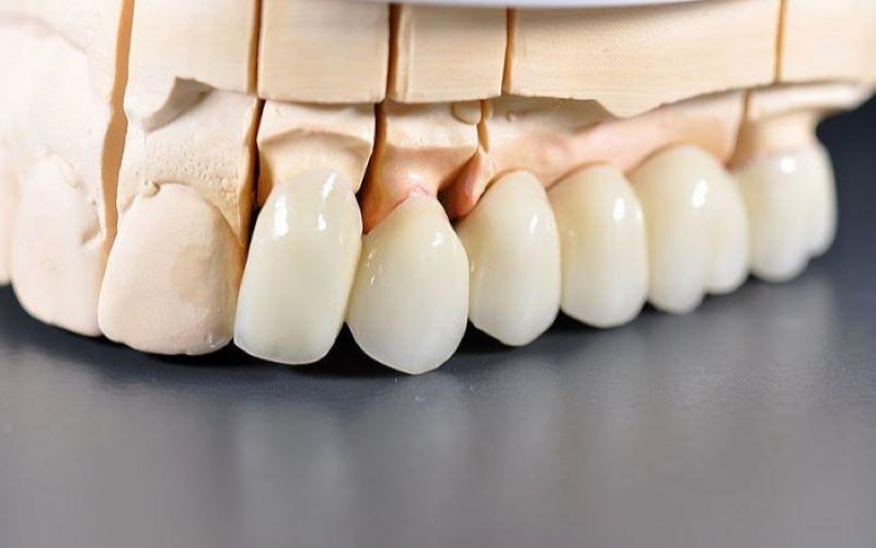 Răng toàn sứ khắc phục hoàn hảo nhược điểm của răng sứ kim loại