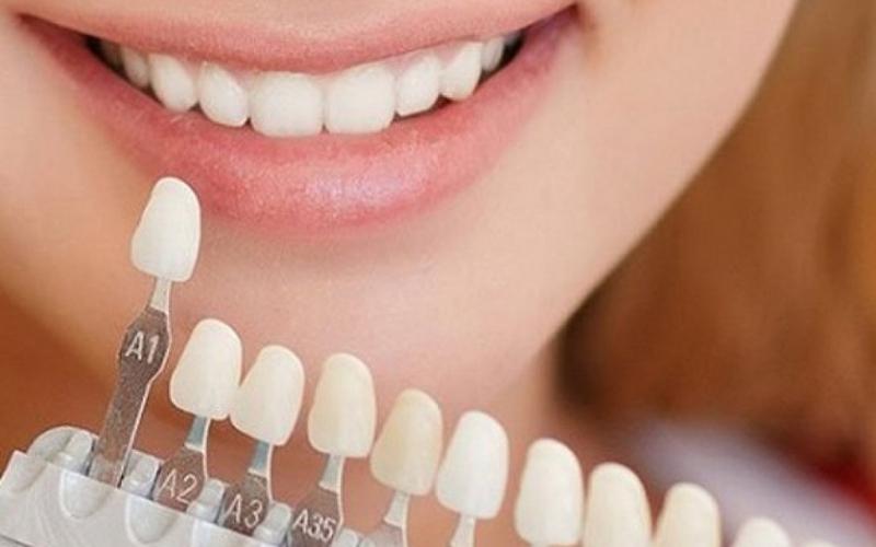 Bọc răng sứ không mài giá bao nhiêu