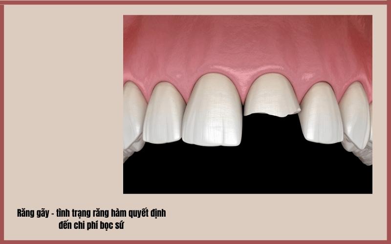 Giá bọc răng sứ không mài phụ thuộc nhiều vào tình trạng răng