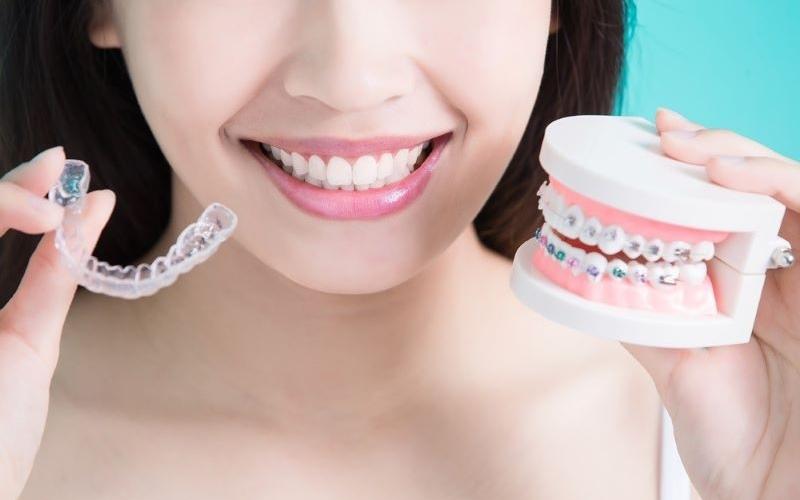 Niềng răng trong suốt đem lại nhiều ưu điểm vượt trội so với phương pháp khác