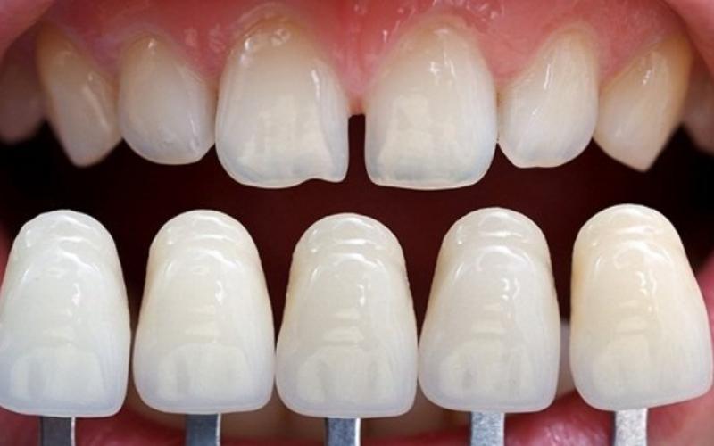 Bọc sứ cho răng cửa giúp cải thiện chức năng ăn nhai và tính thẩm mỹ của nụ cười