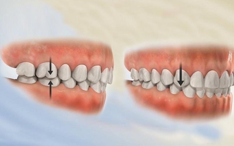 Nâng khớp cắn là phương pháp được bác sĩ sử dụng khi niềng răng