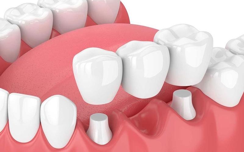 Nếu thực hiện bọc răng sứ tại khu vực ăn nhai, độ bền răng sứ sẽ giảm theo
