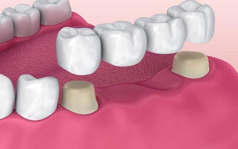 Nhiều người sử dụng phương pháp bắc cầu sứ phục hồi tình trạng bị mất răng