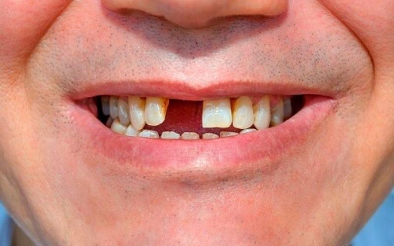Khách hàng mất 1 hoặc nhiều răng nên phục hình