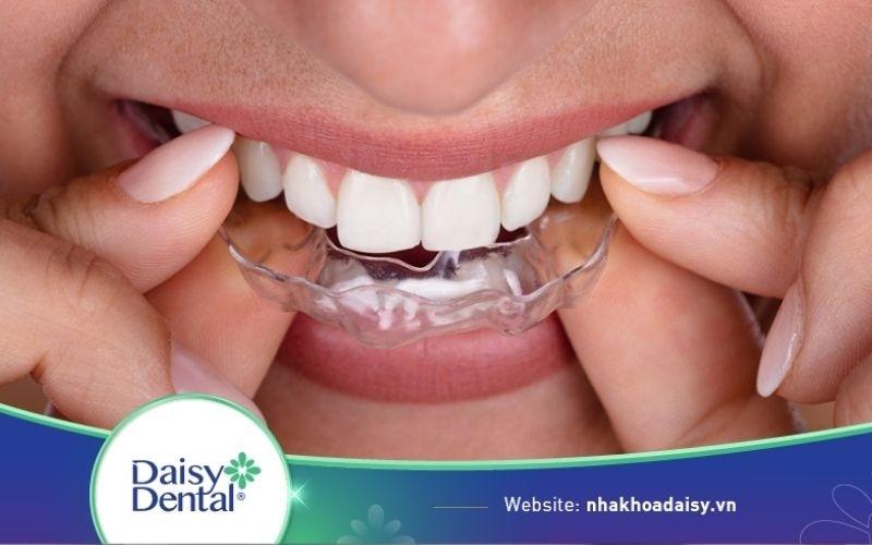 Niềng răng nhựa là gì? Niềng răng bằng nhựa giá bao nhiêu?