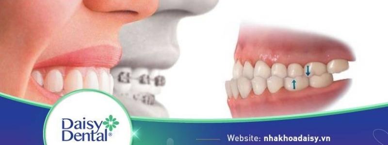 Niềng răng bị quặp vào trong