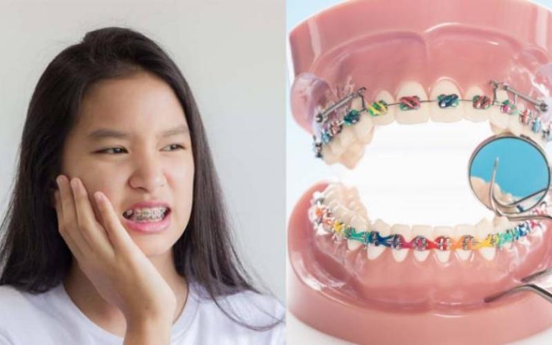 Niềng răng bị sưng lợi là hiện tượng thường thấy ở nhiều người khi chỉnh nha
