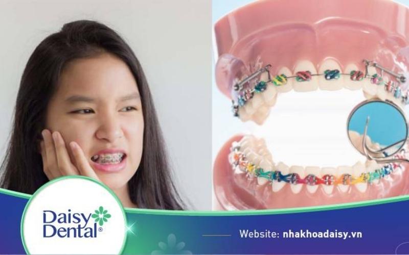 niềng răng bị sưng lợi