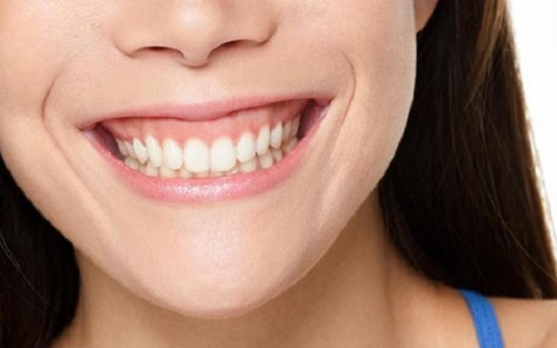 Niềng răng bị hỏng sẽ làm cười hở lợi nặng hơn
