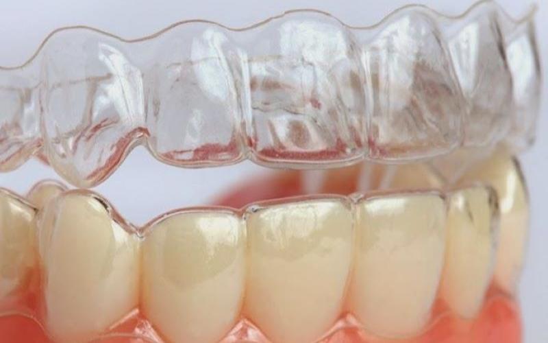 Niềng răng không mắc cài cần khoảng 18 - 36 tháng để có thể thấy kết quả rõ rệt