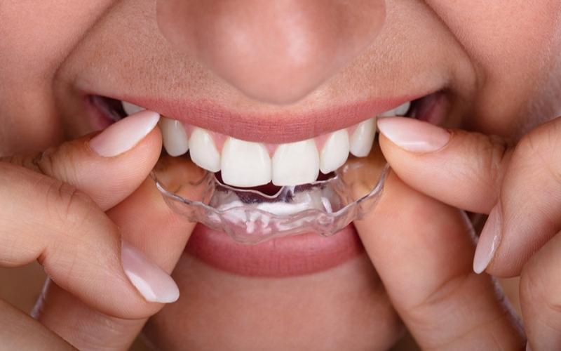 Niềng răng bằng máng nhựa là phương pháp sử dụng khay niềng trong suốt, thiết kế riêng biệt phù hợp với từng mẫu hàm của khách hàng