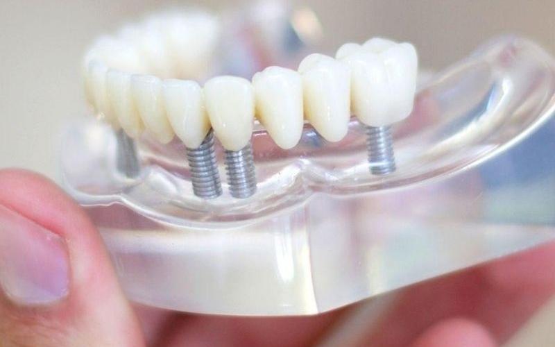 Kỹ thuật phục hình cố định có độ bền cao