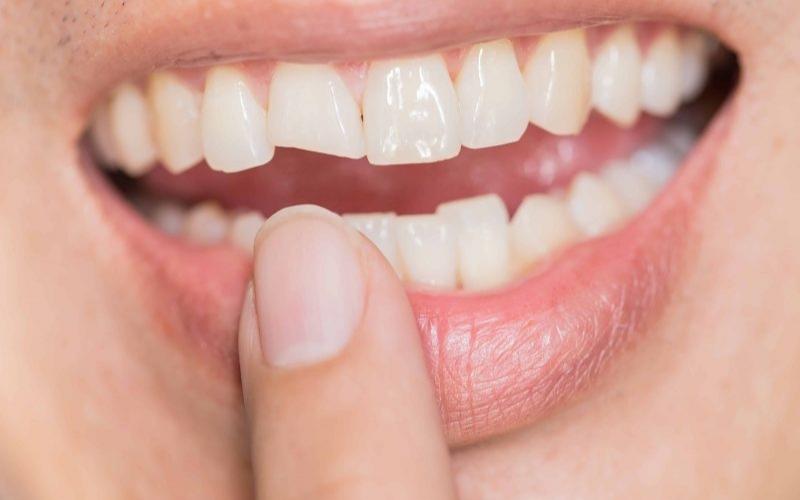 Răng bị mẻ dưới 1/ 3 bạn có thể thực hiện hàn trám răng thẩm mỹ