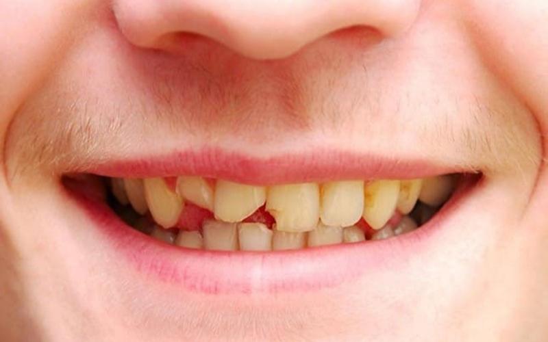 Răng mẻ vỡ kết hợp với ố vàng