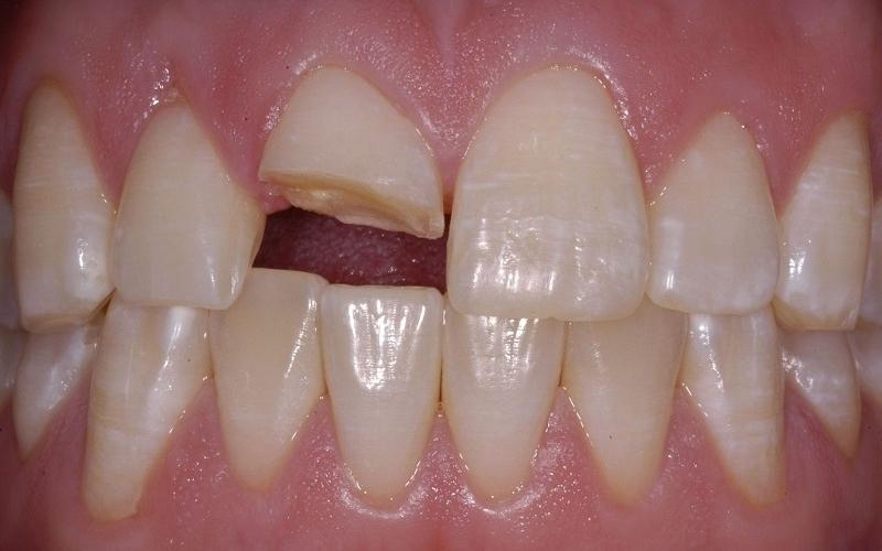 Răng bị mẻ, sứt, thưa có khoảng cách quá lớn, khoảng 2mm mà phương pháp trám không thể khắc phục hiệu quả được