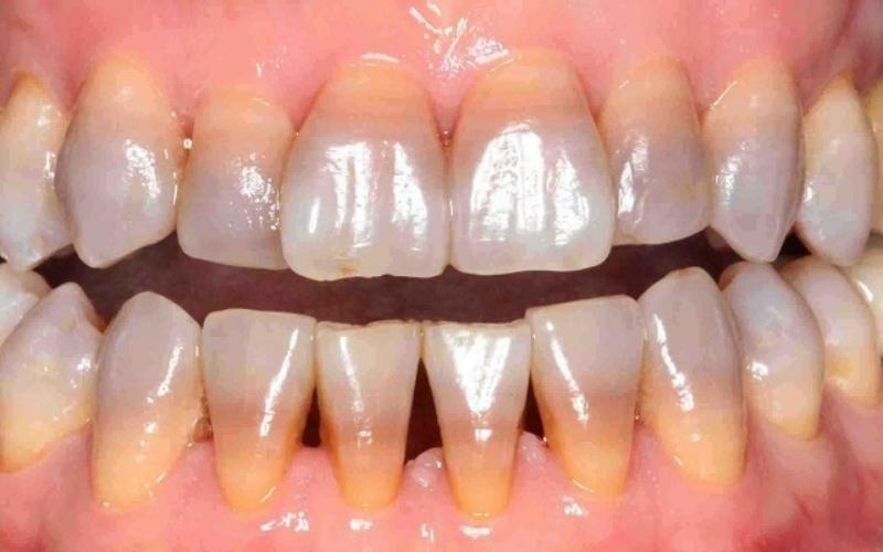 Răng nhiễm màu nặng bạn nên bọc răng sứ