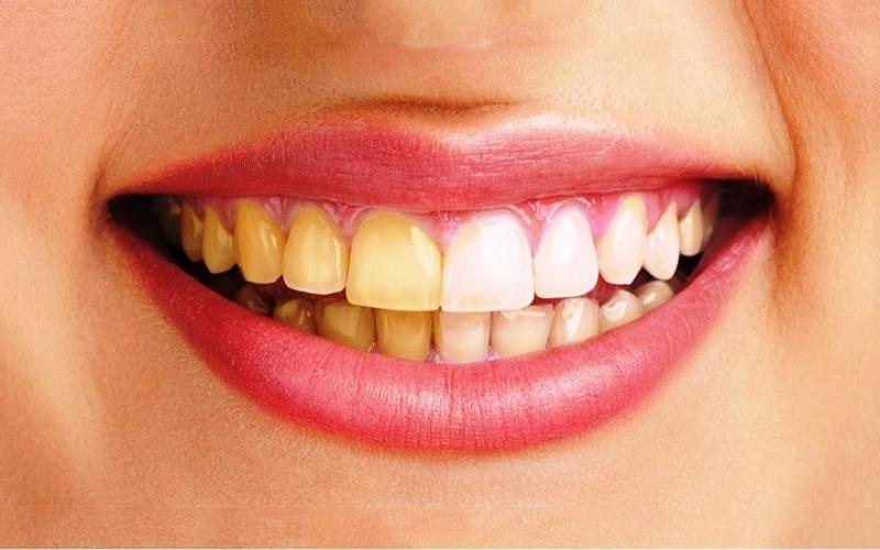 Răng ố vàng xỉn màu có thể khắc phục bằng bọc răng sứ